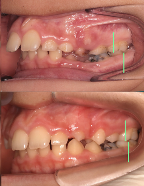 Sviluppo 
Crescita facciale 