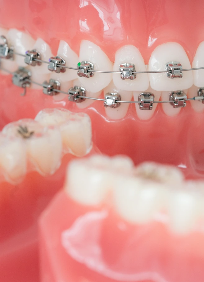 Apparecchio ortodontico fisso e trasparente