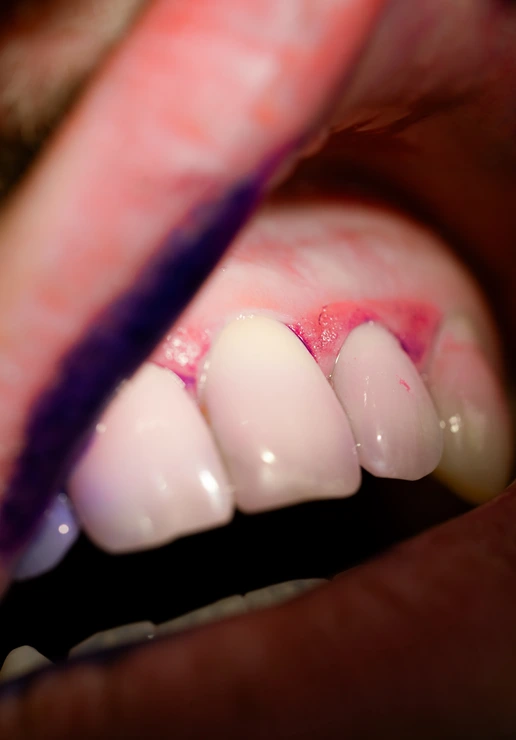 frenulo linguale corto, infiammazione