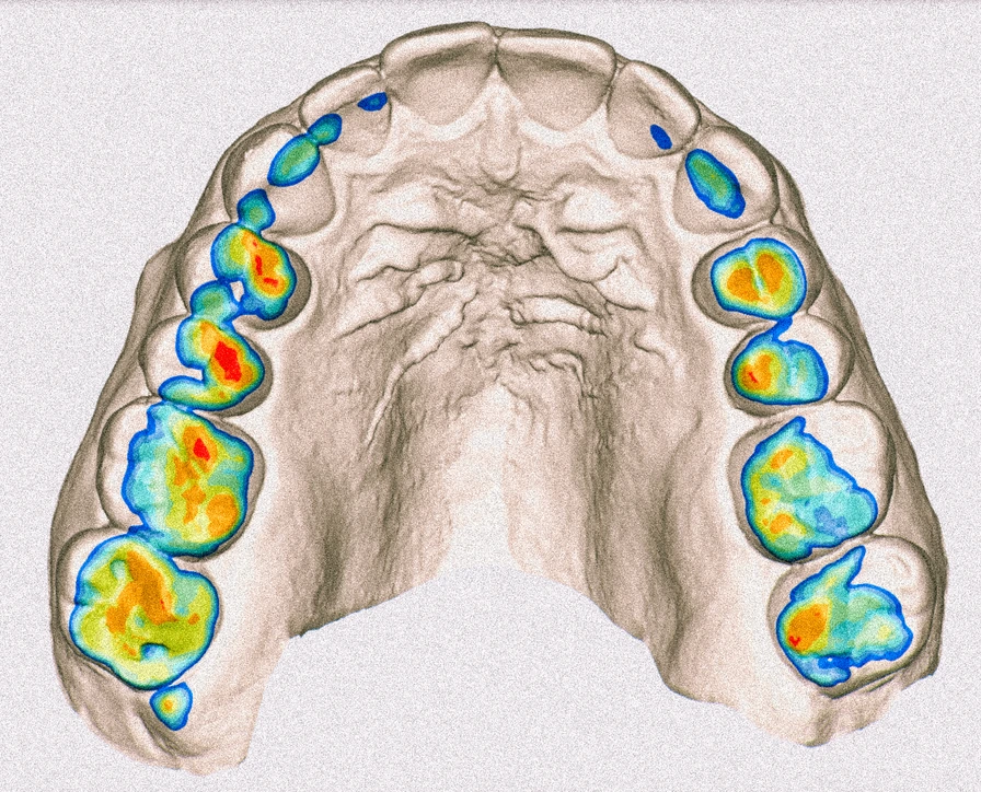 Occlusione dentale
Massima intercuspidazione