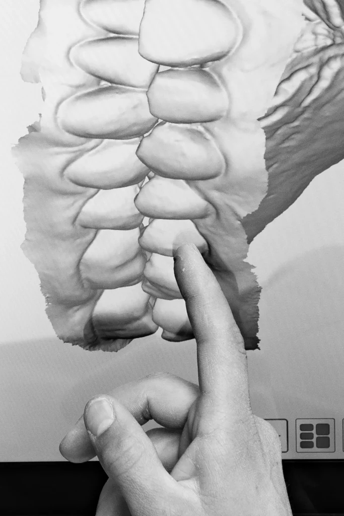 Occlusione dentale 
intercuspidazione