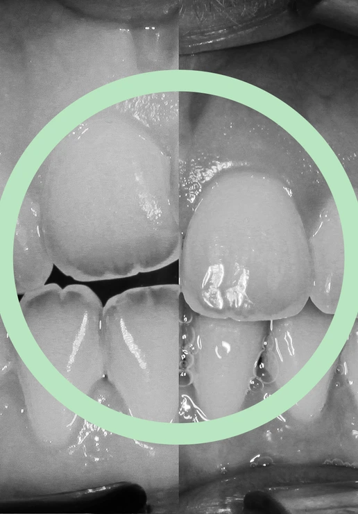 Morso aperto anteriore