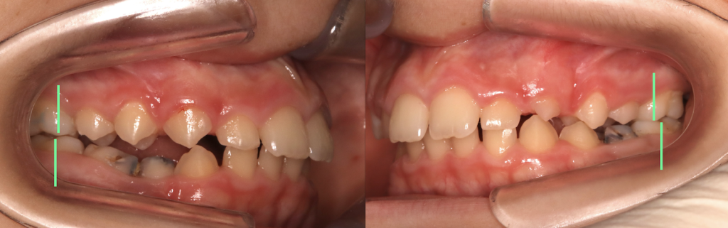 Apparecchio ortodontico miofunzionale