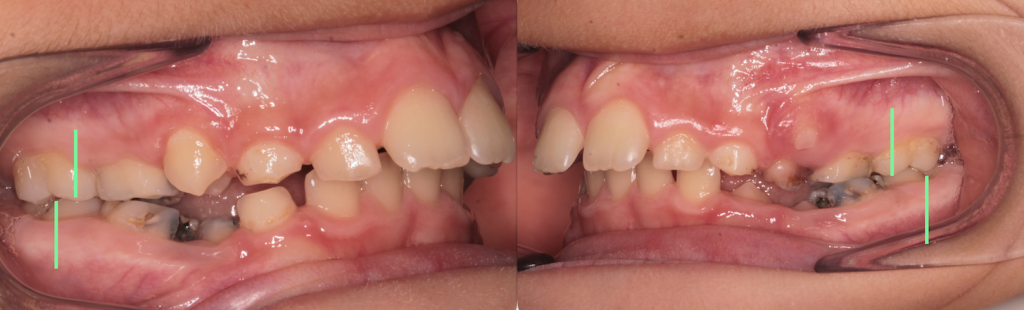 Apparecchio Ortodontico MIofunzionale