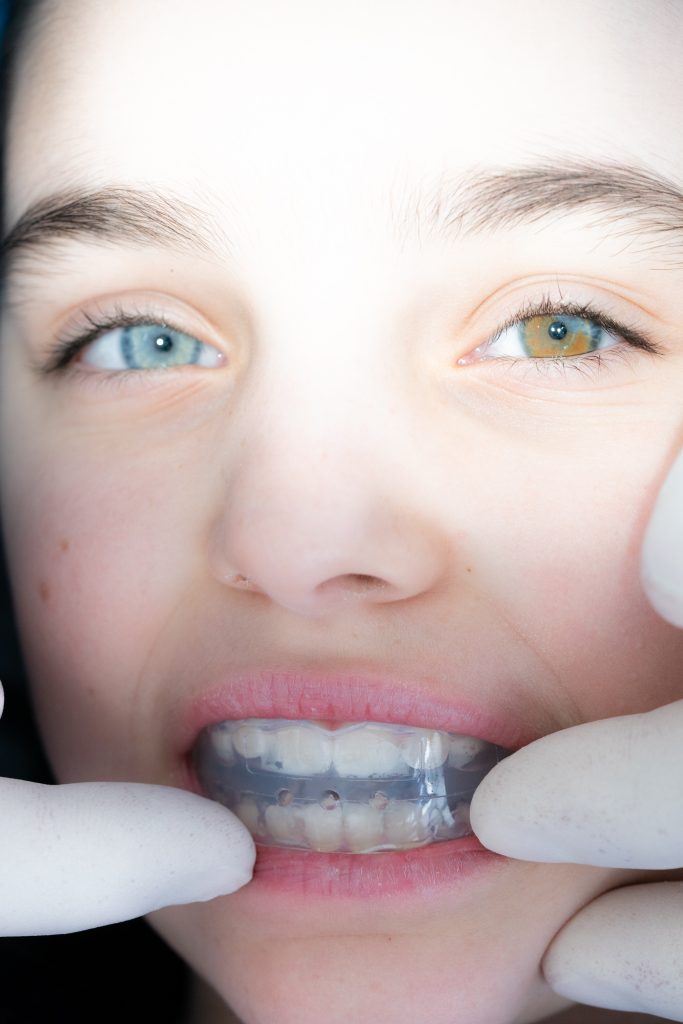 Apparecchio ortodontico miofunzionale, attività fisica