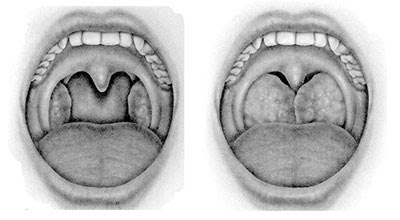 apnea notturna 